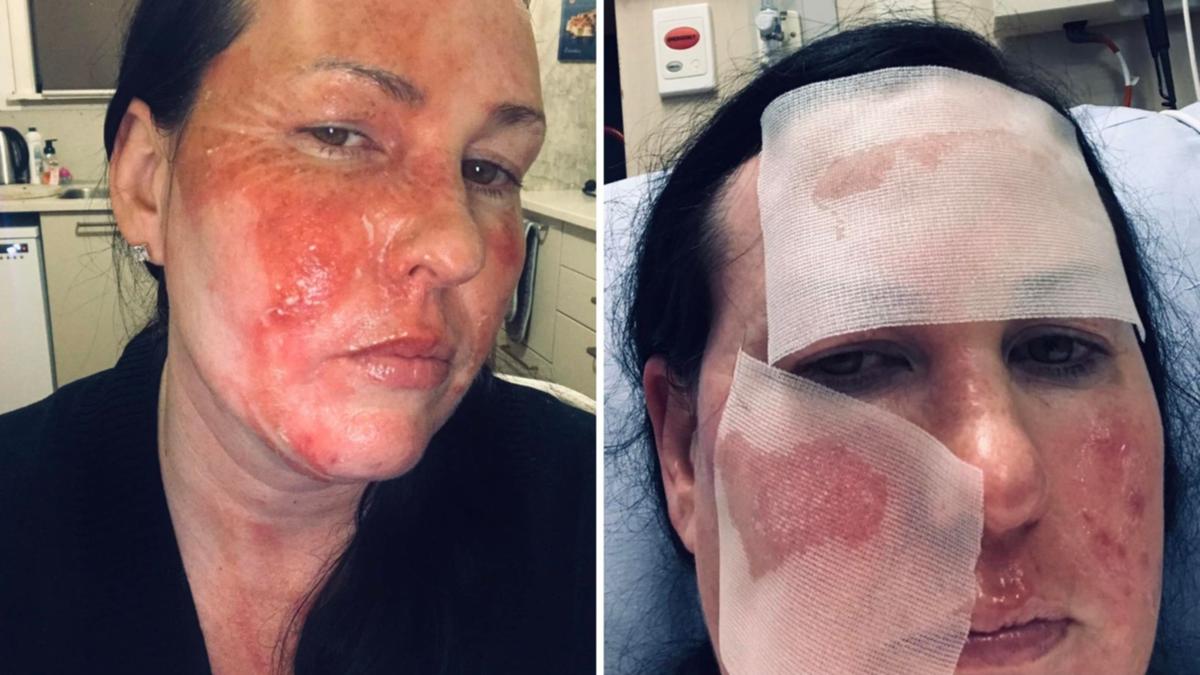 Mum’s warning as ‘slow-cooker explodes like a volcano’ leaving her with devastating burns