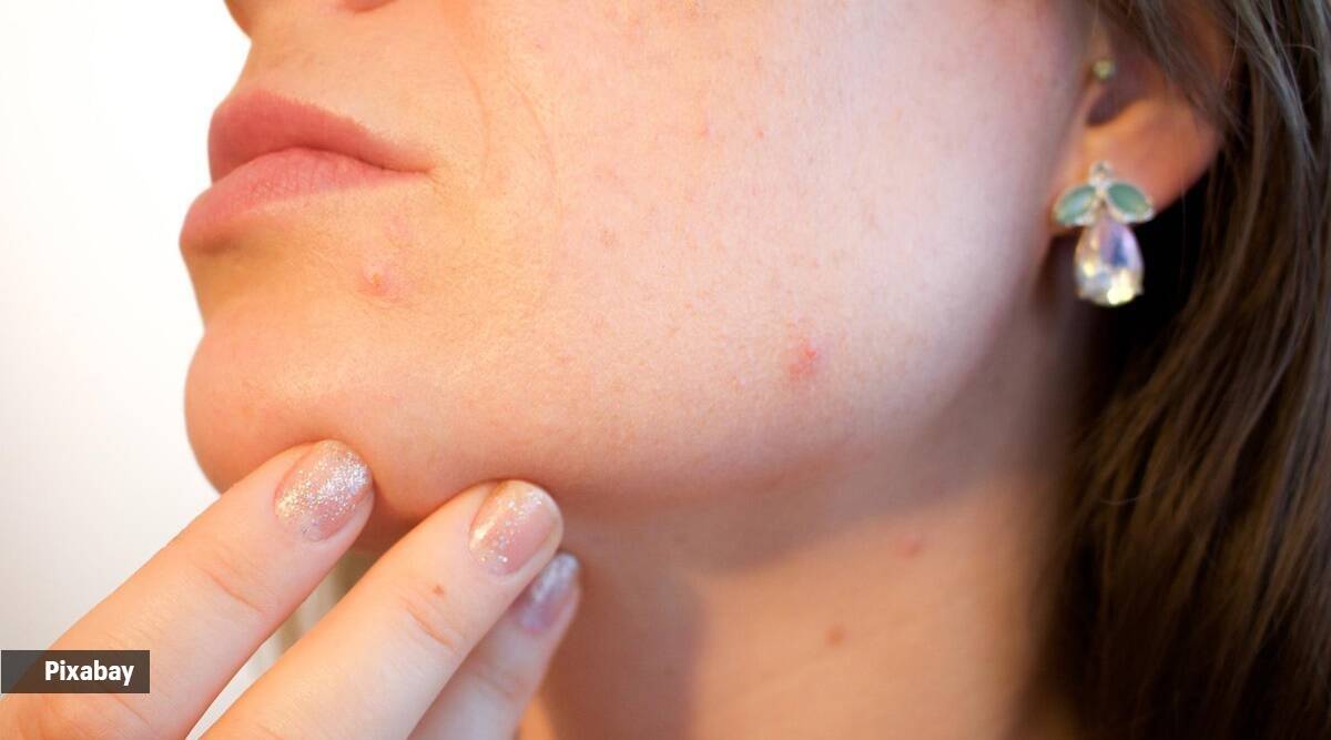 Will popping zits settle it sooner? Discover out right here