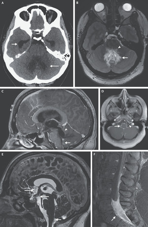 Case 25-2022: A 25-Yr-Outdated Lady with Headache and Blurred Imaginative and prescient | NEJM – nejm.org