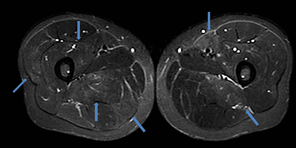 Severe Generalized Epidemic Myalgia in an Adult due to Human Parechovirus Type 3: A Case Report