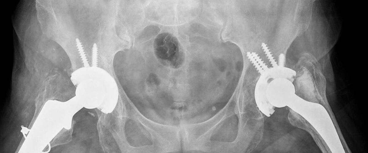 Why you needn’t worry the hip substitute surgical procedure