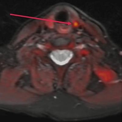 FCH-PET reveals worth detecting tumors in major hyperparathyroidism