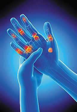 Figuring out arthritis in your fingers and thumbs