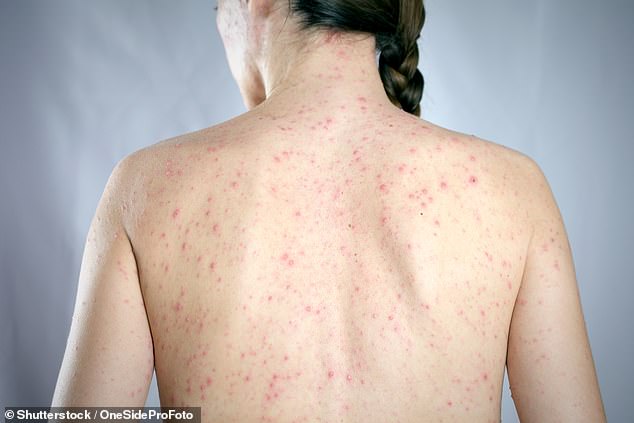 Measles alert in Victoria after traveler visits busy Moonee Ponds procuring strip over a number of days