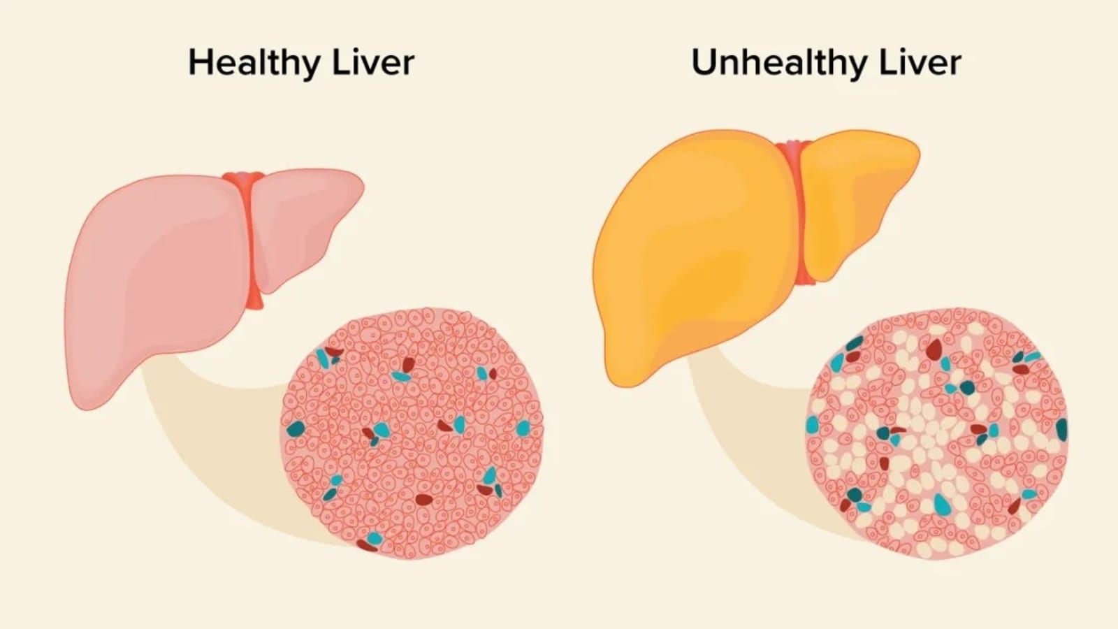 Weight-reduction plan, life-style modifications to deal with fatty liver | Well being