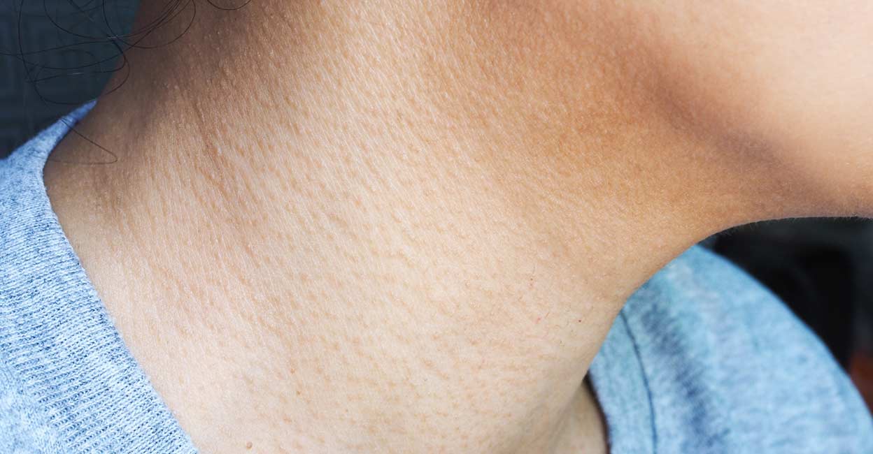 What’s Keratosis Pilaris and easy methods to deal with it successfully | Life-style Well being