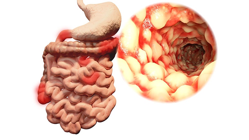 Genetic Danger, Way of life Components Can Result in Grownup-Onset IBD